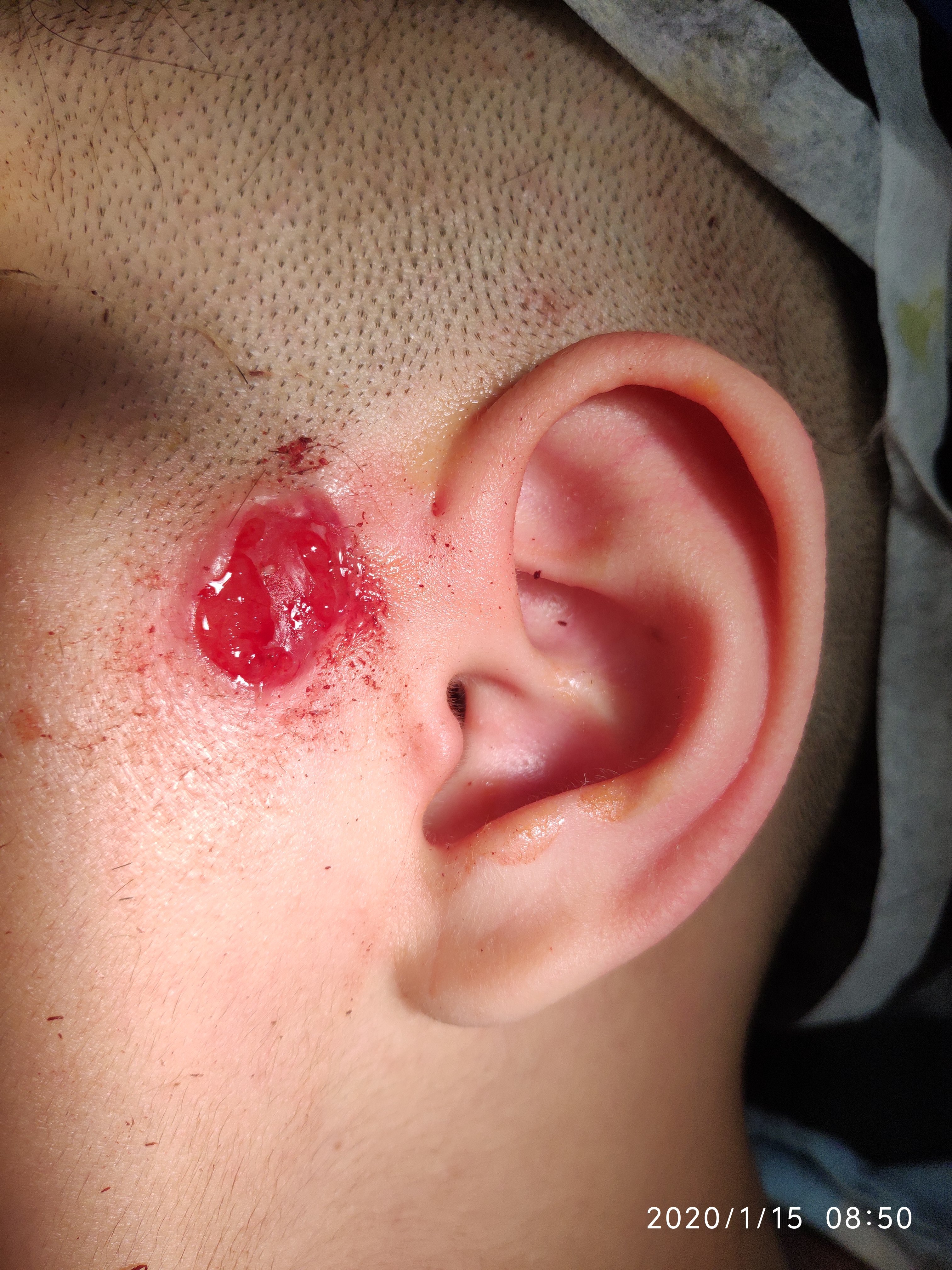 耳前瘘管术后痊愈图片图片