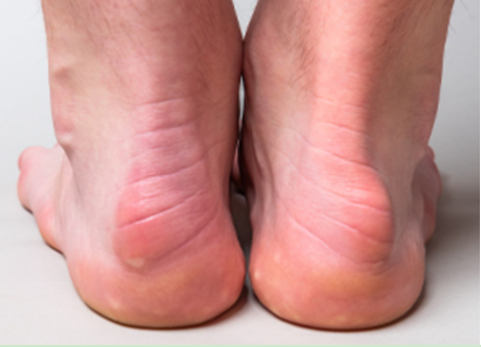 足踝常见病之止点性跟腱炎——记河南省足踝专家第211次会诊