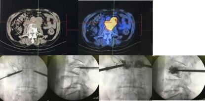 射频消融联合骨水泥填充治疗椎体转移瘤