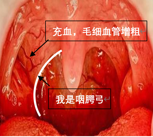 舌腭弓慢性充血图片