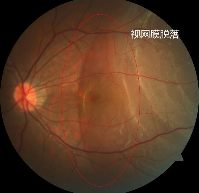 视网膜脱落看到的画面图片