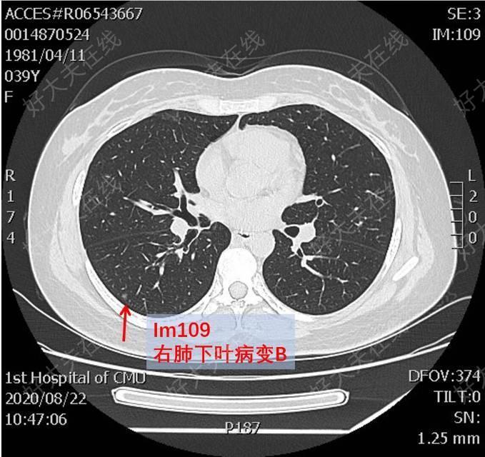 肺磨玻璃結節_肺癌 - 好大夫在線