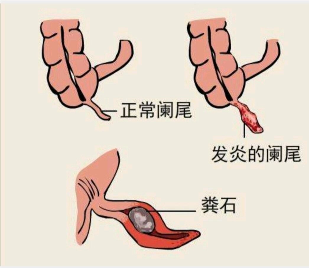 女性阑尾炎的症状表现图片