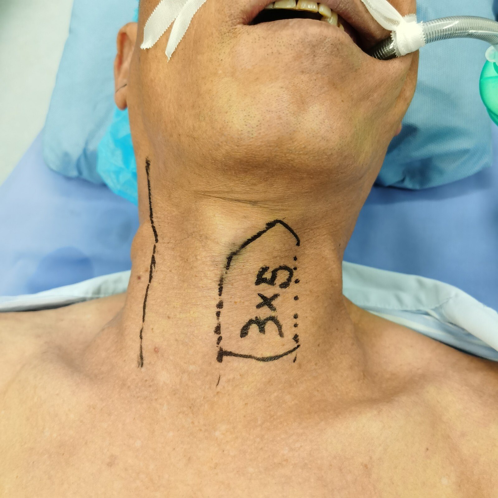 神奇的“割喉”手术，说说气管切开那些事-绍兴袍江医院