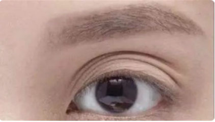 多重睑形成的原因及解决方法 眼部整形 眼部整形