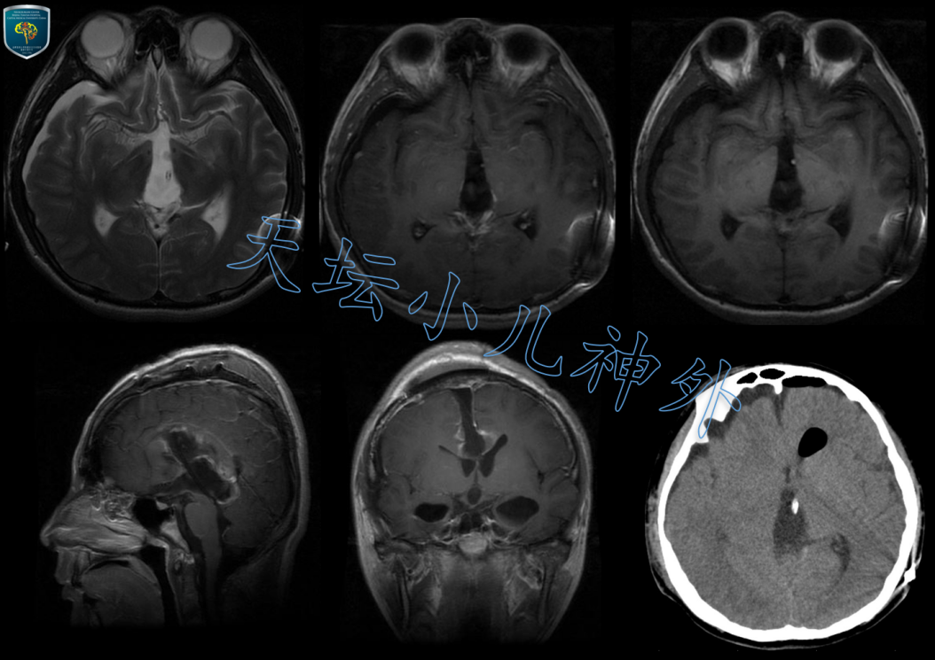 外科治疗儿童松果体区肿瘤的"天坛术式"值得大力提倡_松果体瘤_松果体