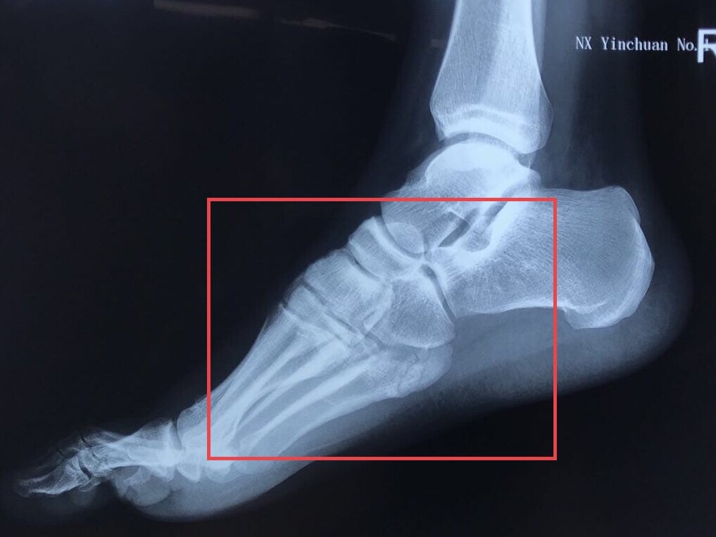 第五跖骨基底部陈旧骨折的认识与处理 跖骨骨折 第五跖骨基底部陈旧骨折的认识与处理 跖骨骨折