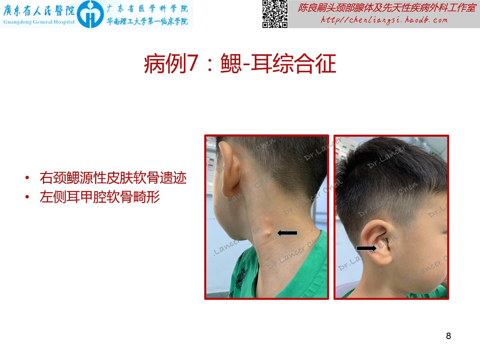 医学科普 易被疏忽的鳃 耳 肾综合征 医学科普 易被疏忽的鳃 耳 肾综合征