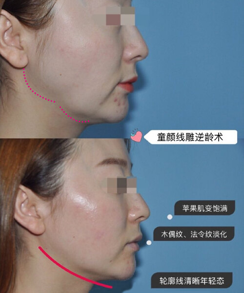 苹果肌下垂应该怎么办 如何进行改善 微整形除皱 微整形除皱