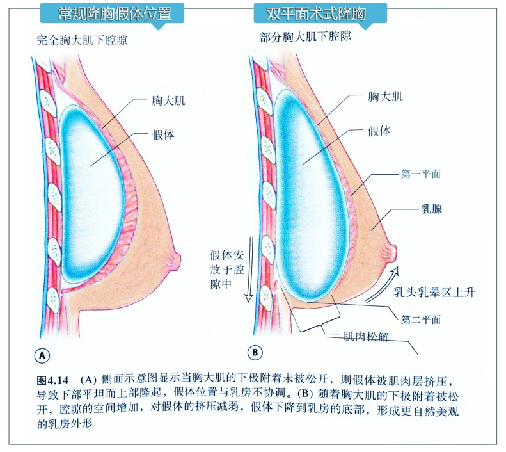 双平面示意图.png