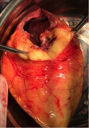 致心律失常性右室心肌病_心律失常_介绍_症状表现_治疗方式 - 好大夫