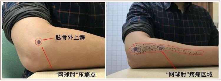 肱骨外上髁炎,因多见于网球运动员而被冠名"网球肘",表现为按压肘关节