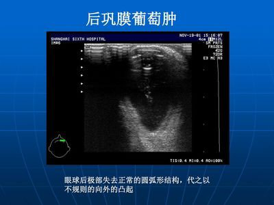 科普| 后巩膜葡萄肿是"肿瘤"吗?_巩膜葡萄肿_介绍_检查 - 好大夫在线
