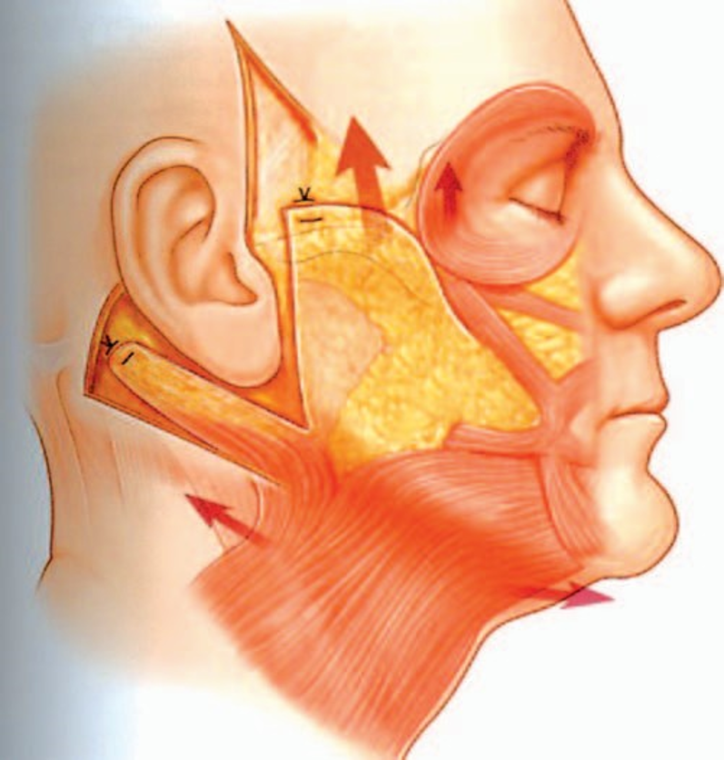 1992年hamra提出了复合组织提升术,把皮肤,颈阔肌,颧脂肪垫,眼轮匝肌