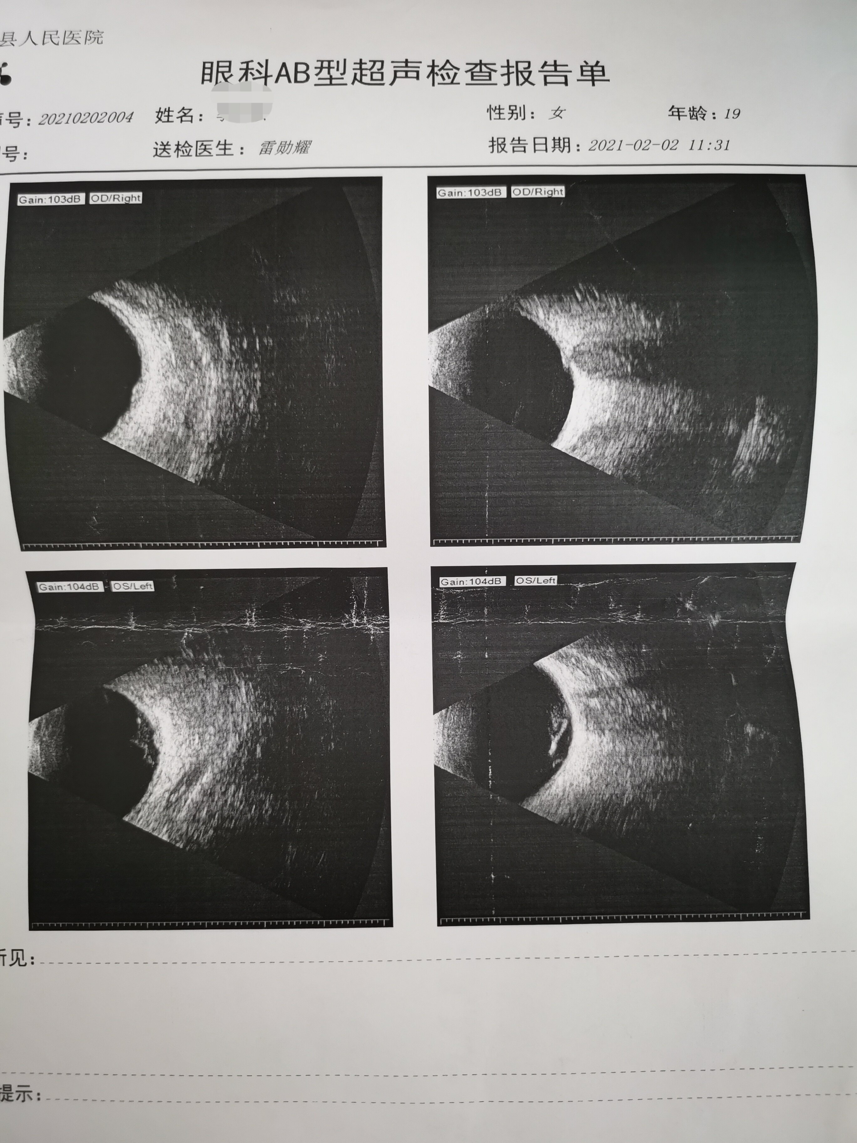 玻璃体出血超声报告图片
