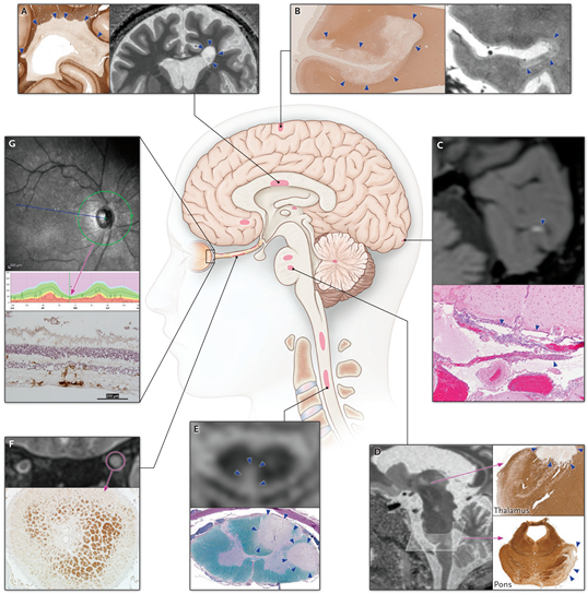 sclerosis,ms)是一種免疫介導的中樞神經系統慢性炎性脫髓鞘性疾病,常