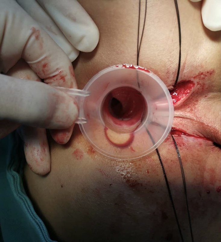 混合痔嵌顿伴坏死的手术治疗 患者男性,46岁,"反复肛门肿物脱出1年,不