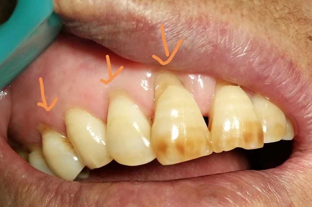 牙根上的横沟是怎么回事
