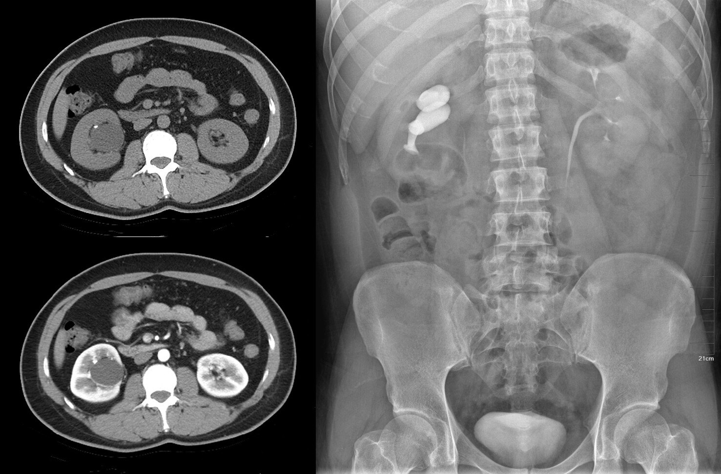 复杂性肾囊肿和囊性肾癌的鉴别诊断 - 好大夫在线