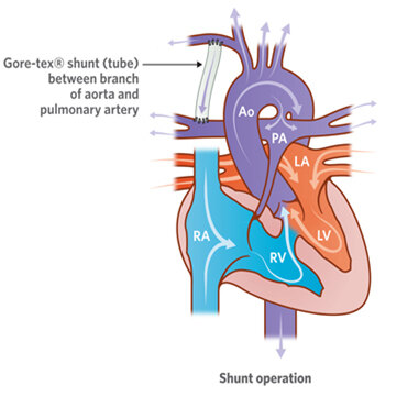 合并室间隔缺损的肺动脉闭锁