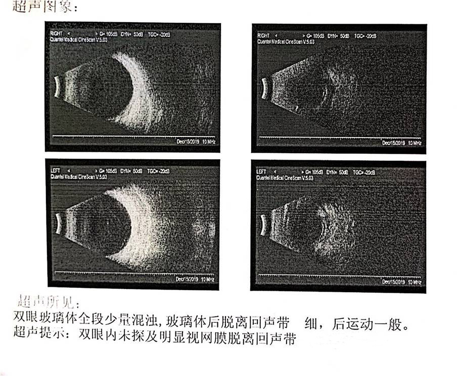 眼前段照相②眼科检查糖尿病病史.