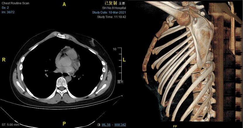 鸡胸矫正经典案例集合1 - 好大夫在线