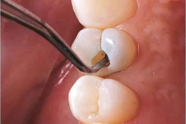 补牙后牙齿疼痛的原因有哪些?