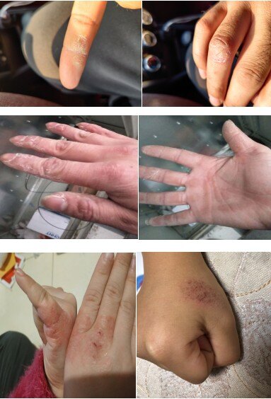 洗手过于频繁可能会导致手湿疹_手部湿疹_介绍_发病原因 - 好大夫在线