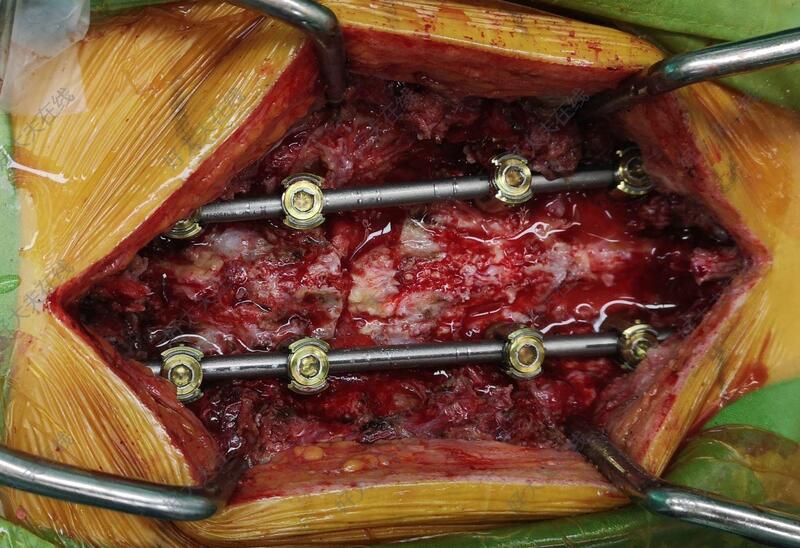 術中於胸10,胸11,腰1,腰2椎體置入骨水泥椎弓根螺釘.