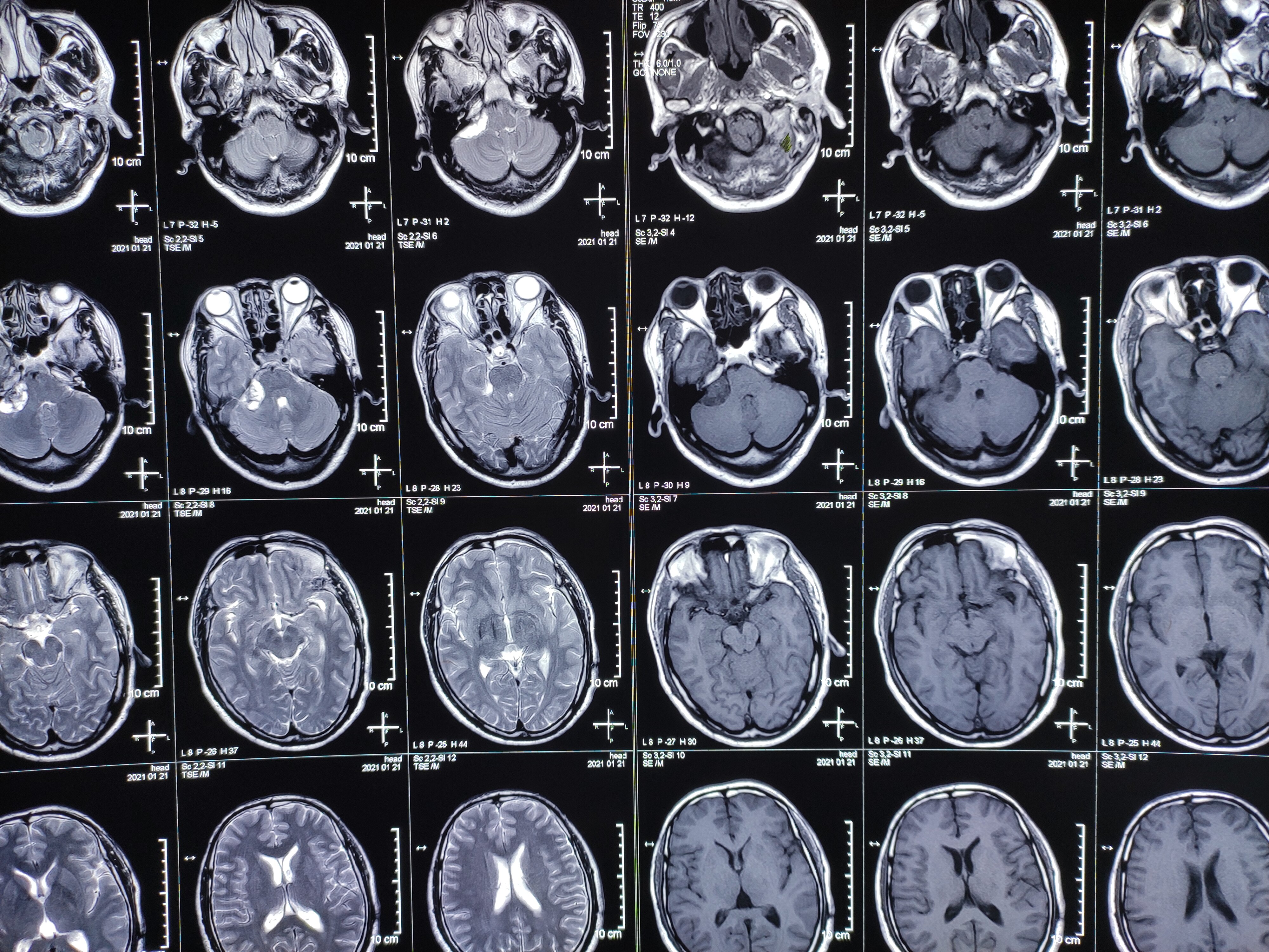 听神经瘤手术全切,术后无面瘫 - 好大夫在线