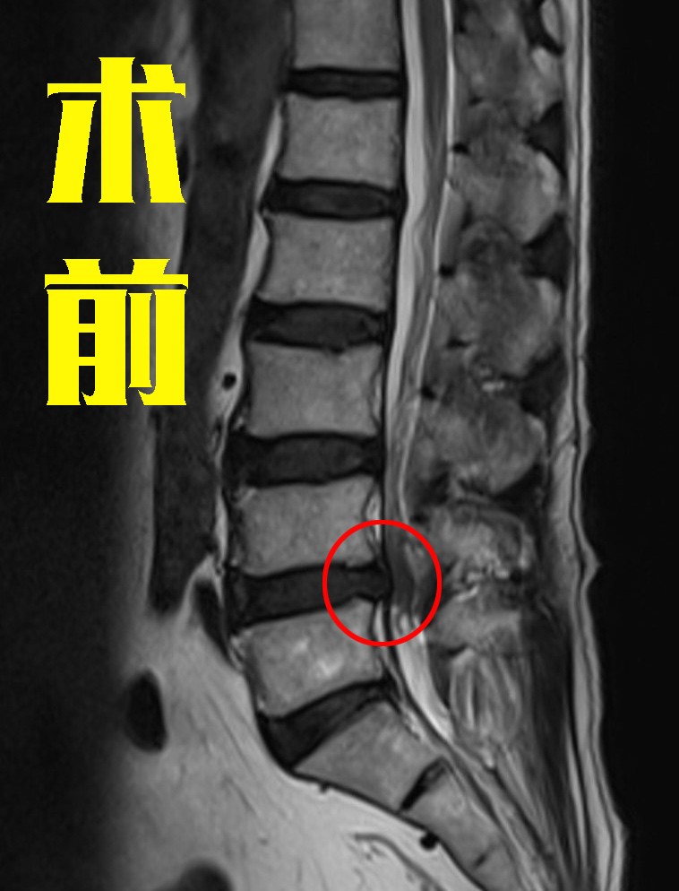 腰椎4 5节清晰图片图片