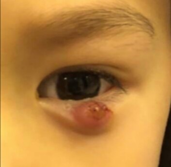 莫把霰粒肿当麦粒肿延误治疗 Eos超脉冲新疗法非手术治疗 霰粒肿 饮食运动 症状