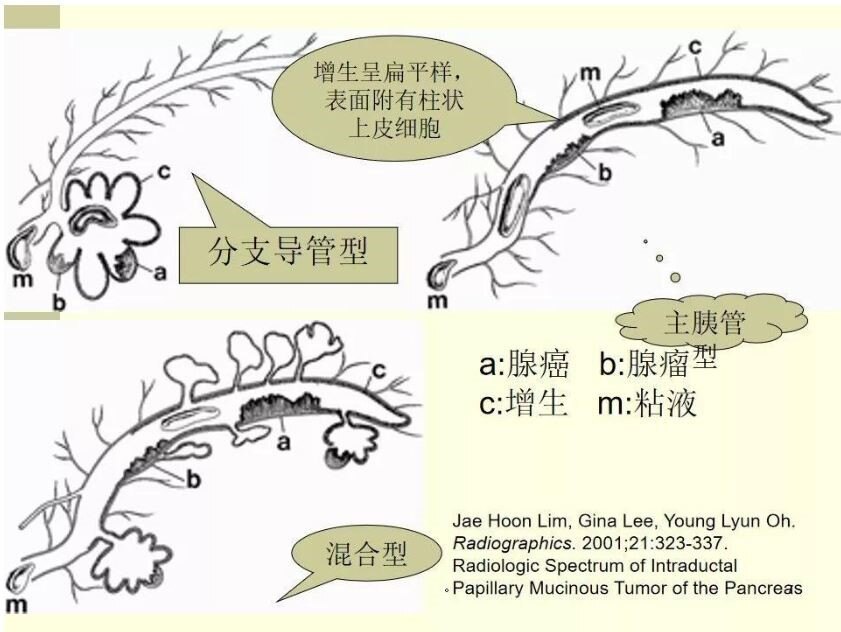 胰管型ipmn图片