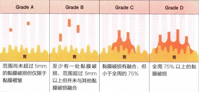 伏诺拉生与反流性食管炎
