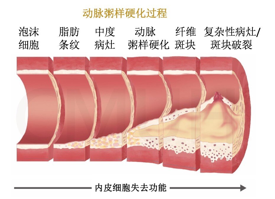 颈动脉狭窄的危害和治疗