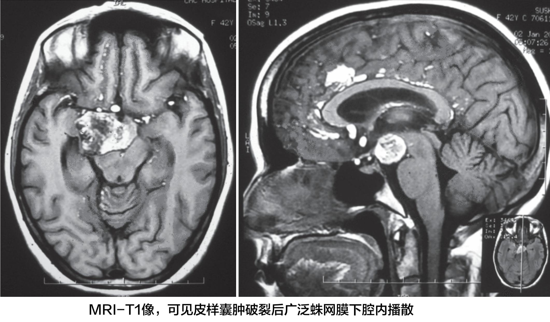 颅骨囊肿图片