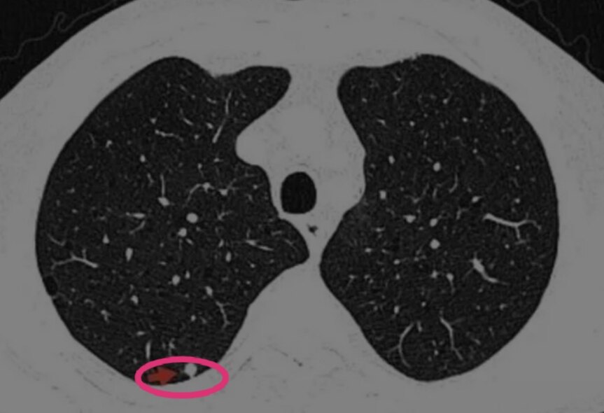 肺部5mm微小实性结节,有可能是恶性程度最高的肺癌_肺癌_症状表现