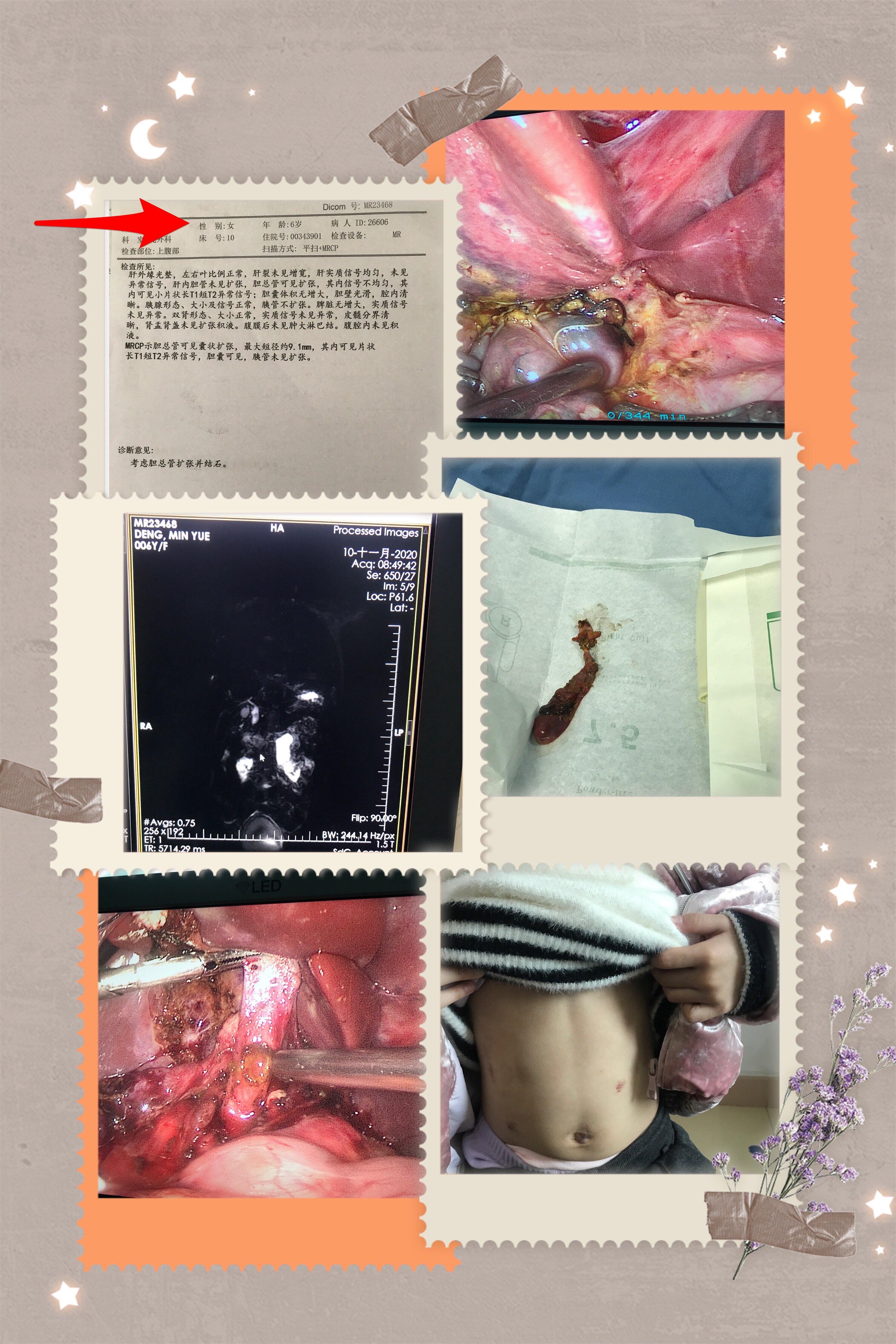 胆结石治疗费用_胆结石治疗贵吗_治疗胆结石花多少钱