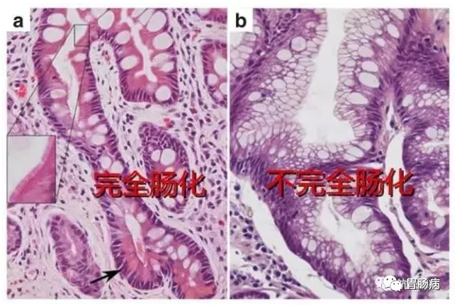 慢性萎缩性胃炎