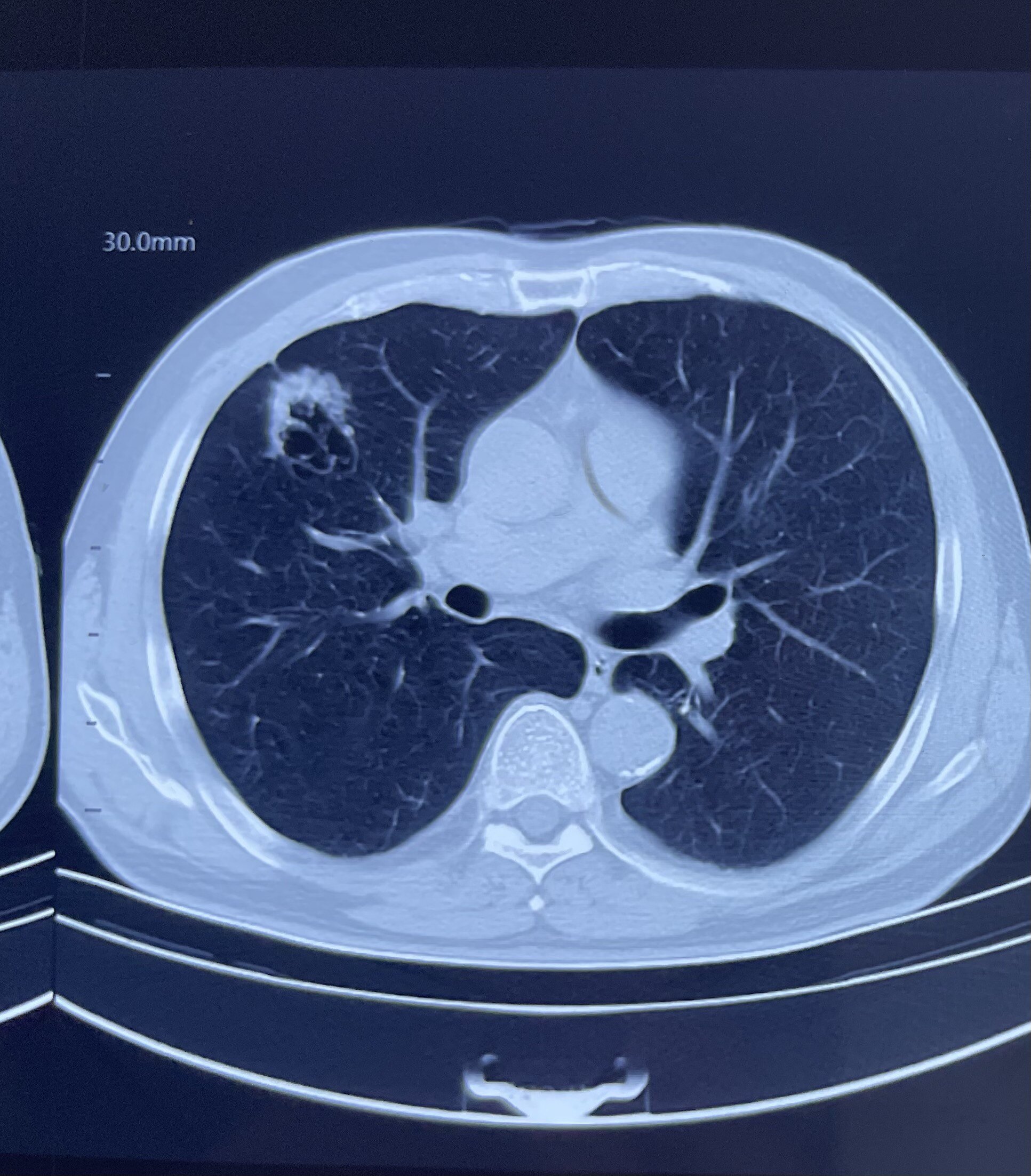 肺大泡ct表现图片图片