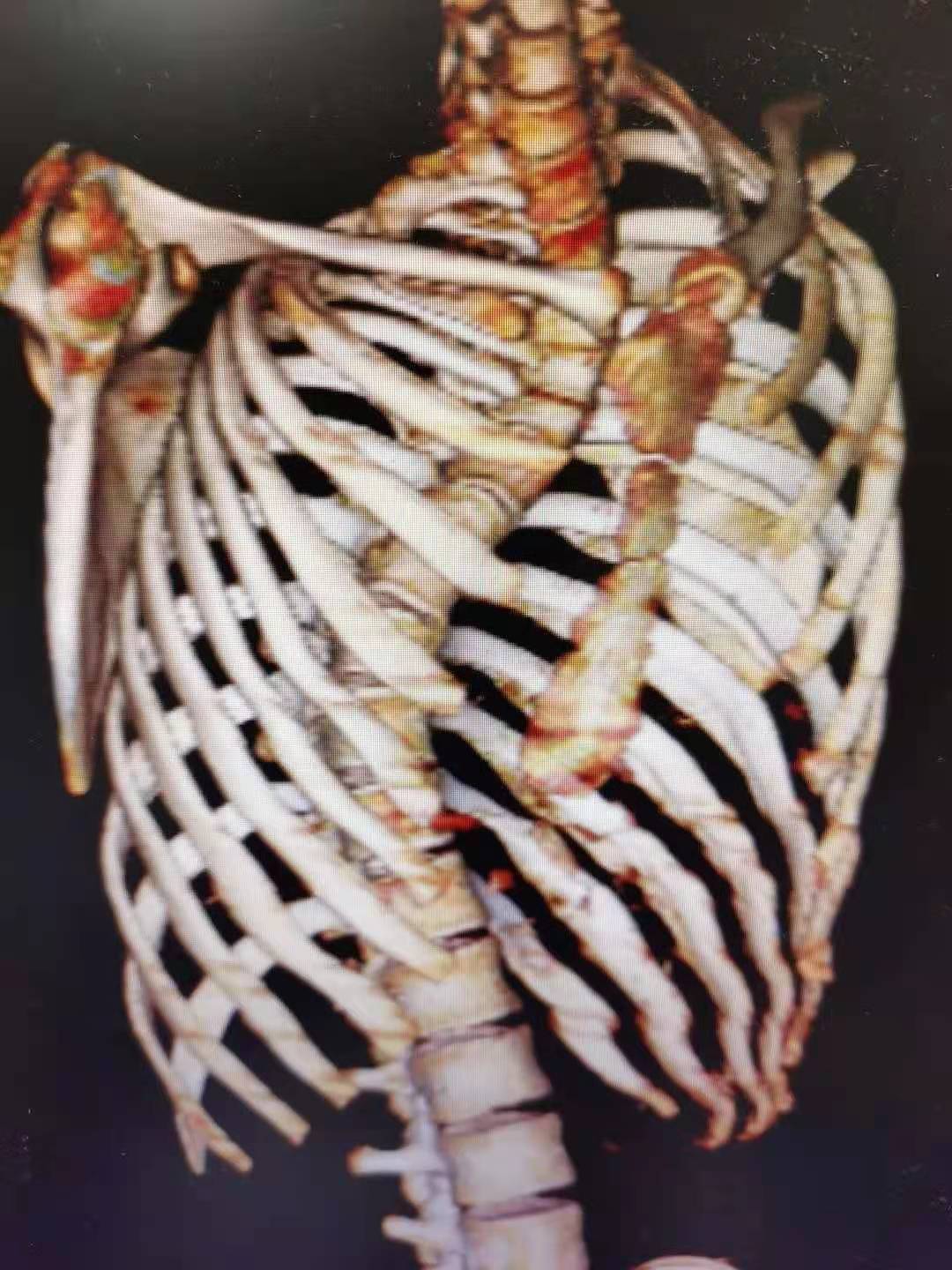 胸下面凸起来的骨头图片