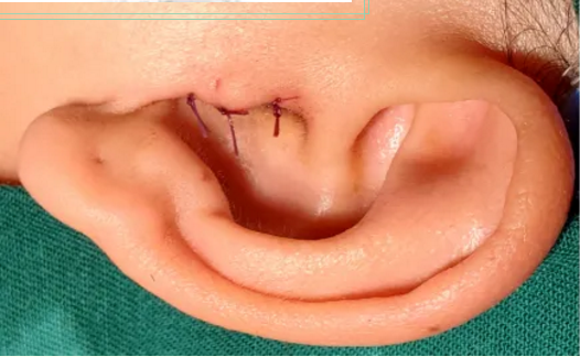 中耳炎,需要手术治疗吗?