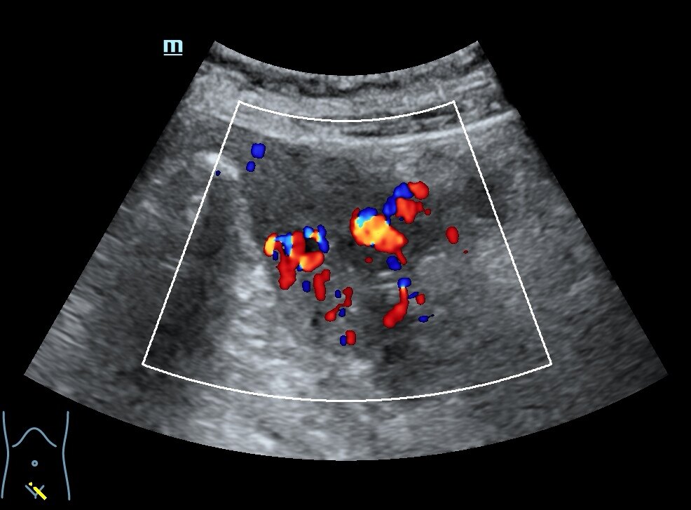 子宫动静脉瘘超声图片