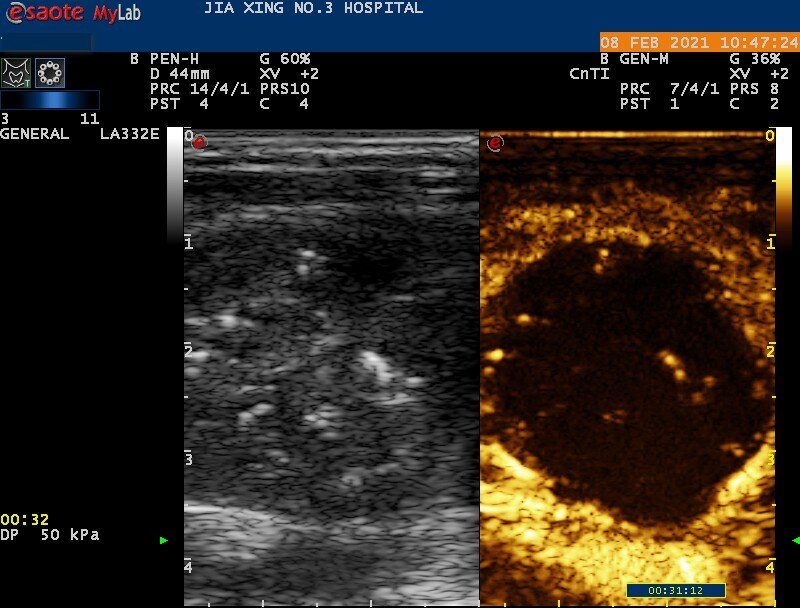 精选病例1超声引导下甲状腺多发结节射频消融术穿刺硬化术