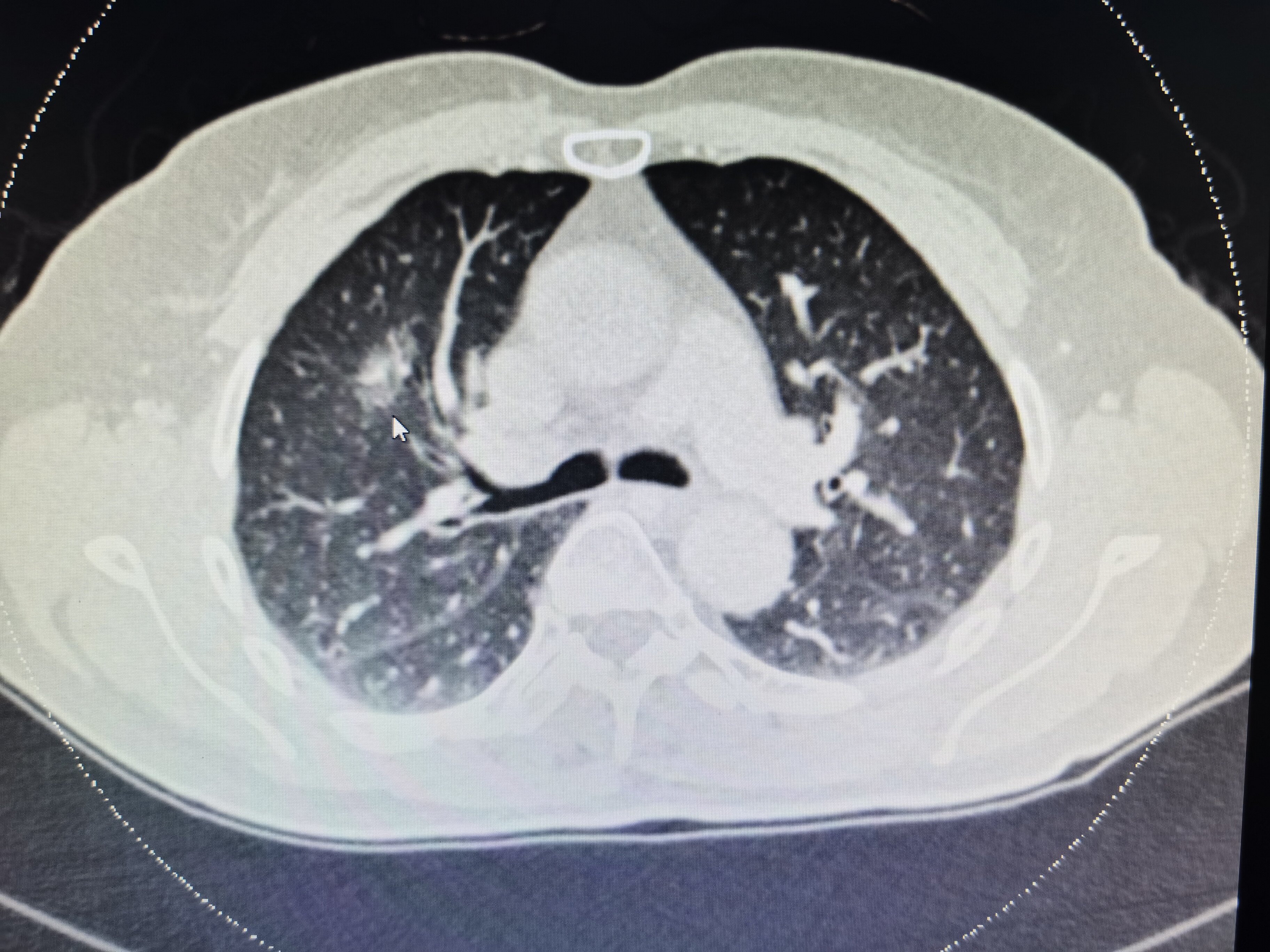 肺结节影像图 恶性图片
