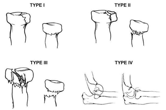 桡骨头骨折的mason分型 - 好大夫在线