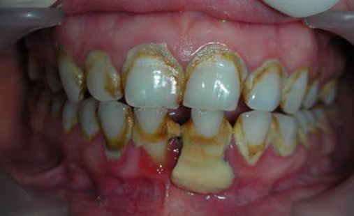 洗牙会不会让牙齿松动 牙周炎 牙周炎