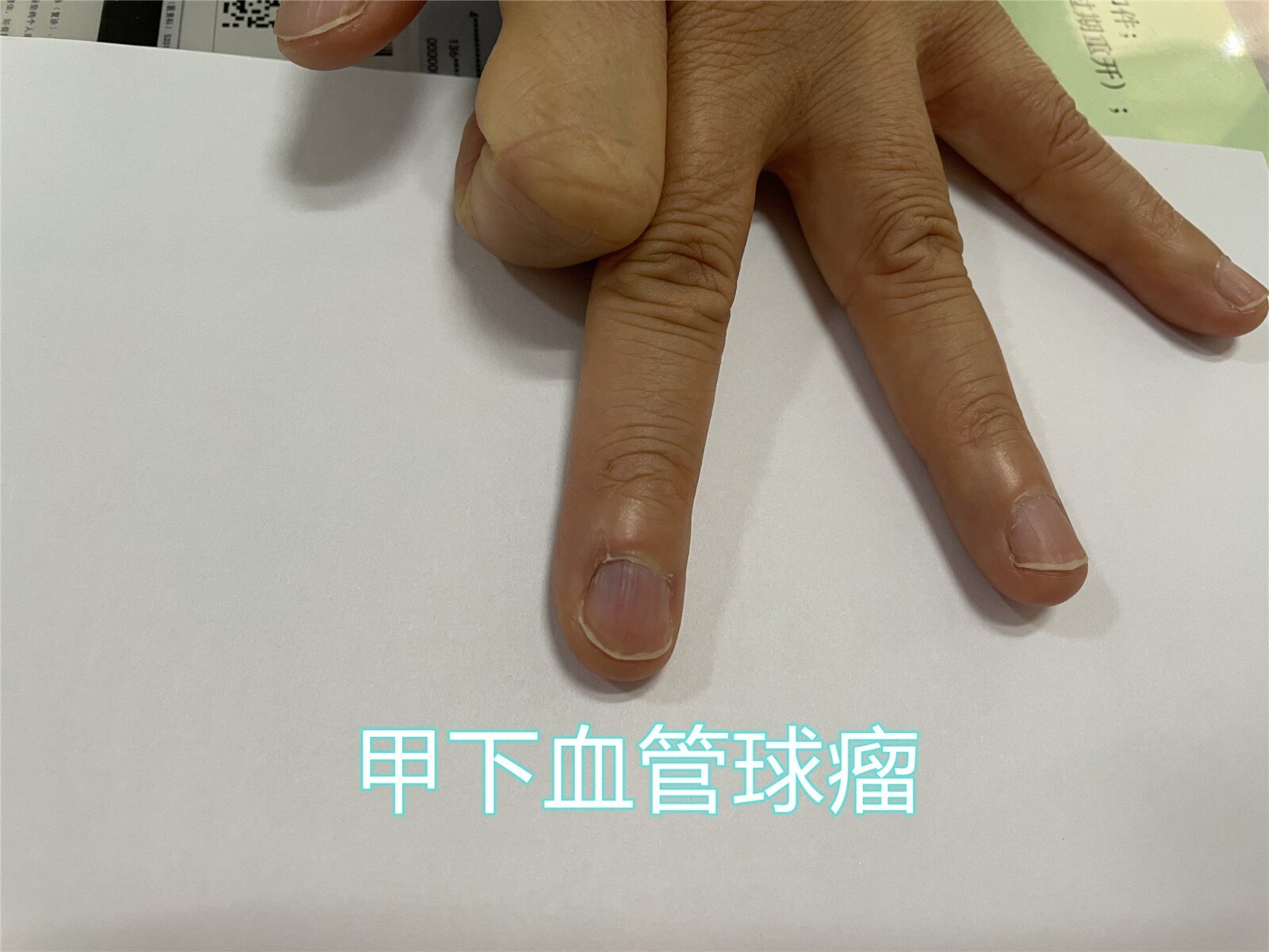 恶性神经鞘瘤能治愈么_黑色素瘤能治愈吗_艾兰得关节活素氨基葡萄糖硫酸软骨素片能治愈类风湿吗