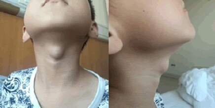 儿童甲状舌管囊肿图片