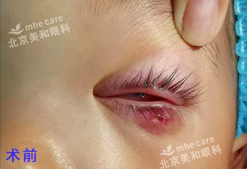 莫把霰粒肿当麦粒肿延误治疗 Eos超脉冲新疗法非手术治疗 霰粒肿 饮食运动 症状